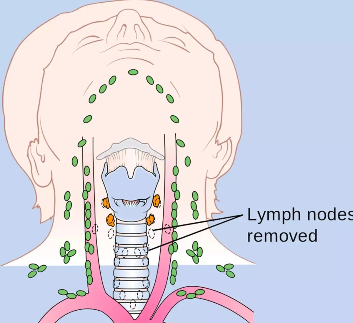 Лимфатические узлы щитовидной железы анатомия. Лимфоотток щитовидной железы. Лимфоузлы на щитовидке