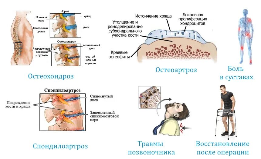 Остеохондроз локальный статус. Спондилоартроз. Спондилоартроз позвоночника. Остеохондроз спондилоартроз. Спондилоартроз межпозвонковых дисков.