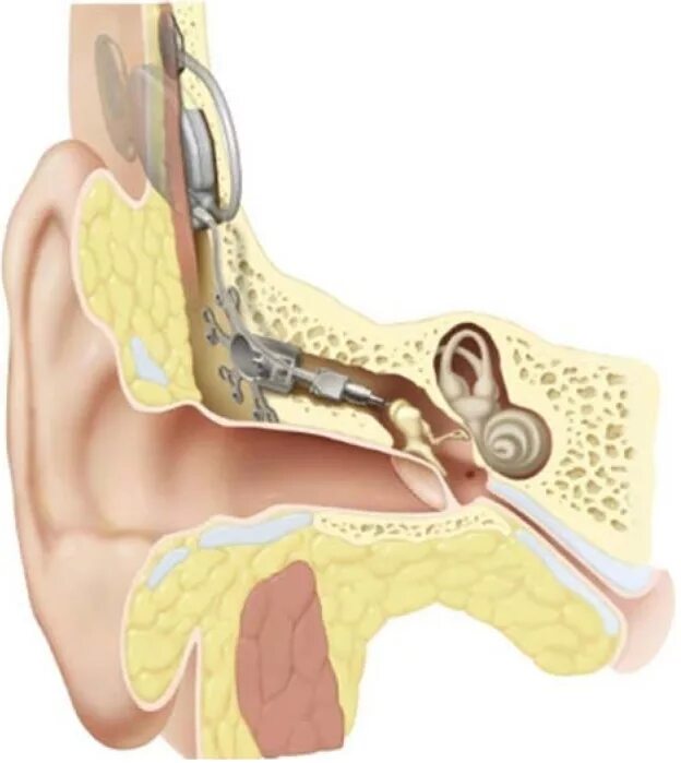 Кохлеарный отосклероз. Отосклероз слуховой аппарат. Тимпанопластика уха протез слуховых косточек. Тимпанопластика уха холестеатома. Отосклероз уха операция