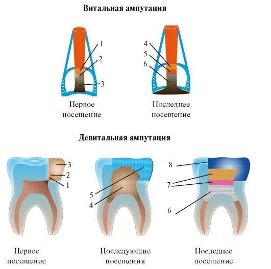 Пульпит витальная экстирпация. Этапы витальной экстирпации пульпы схема. Этапы витальной ампутации пульпы (схема).. Метод девитальной ампутации пульпы схема.