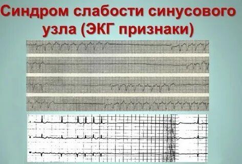 Синдром слабости синусового узла на экг