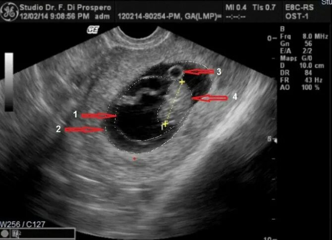 7 неделя не видно эмбриона. УЗИ 7 недель беременности фото. УЗИ 7 акушерских недель беременности фото. УЗИ беременной 7 недель. Снимок УЗИ на 7 неделе беременности.