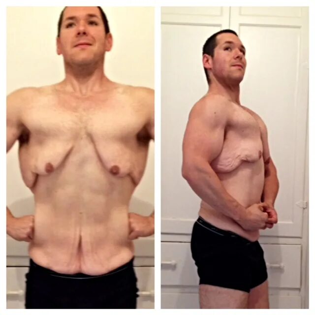 Операция по удалению веса. Липомоделирование живота. Лазерная липосакция живота. Операция по удалению веса. Липосакция и липоскульптурирование.