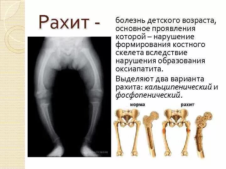 Рахит 6 лет. Кальципенический рахит. фосфопенический рахит.