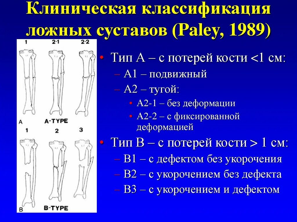 Укорочение трубчатых. Переломы плечевой кости классификация. Классификация ложных суставов. Псевдоартроз классификация. Классификация переломов костей.