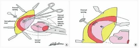 Internal open