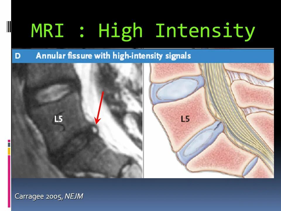 Отдел разрыв. Фиссура фиброзного кольца межпозвоночного диска что это. Фиссура фиброзного кольца диска. Фиссура межпозвонкового диска. Разрыв фиброзного кольца межпозвоночного диска.