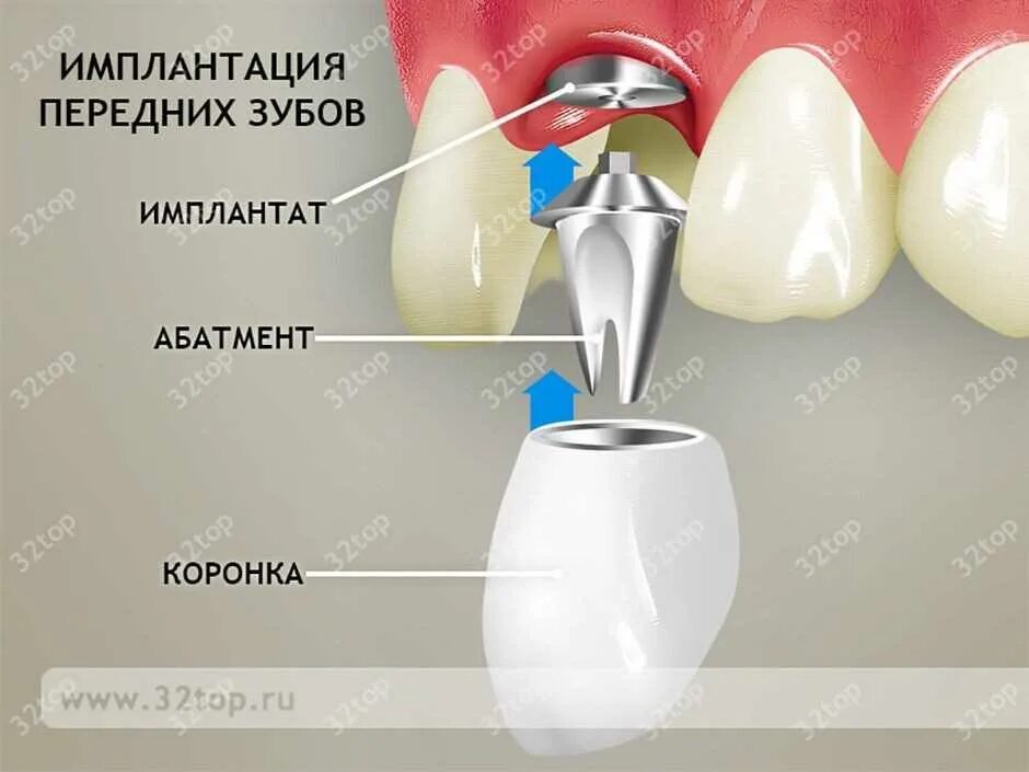 Сколько вставить передний зуб. Имплантация переднего зуба. имплантант на переднем зубе. имплантация зубов передних зубов.