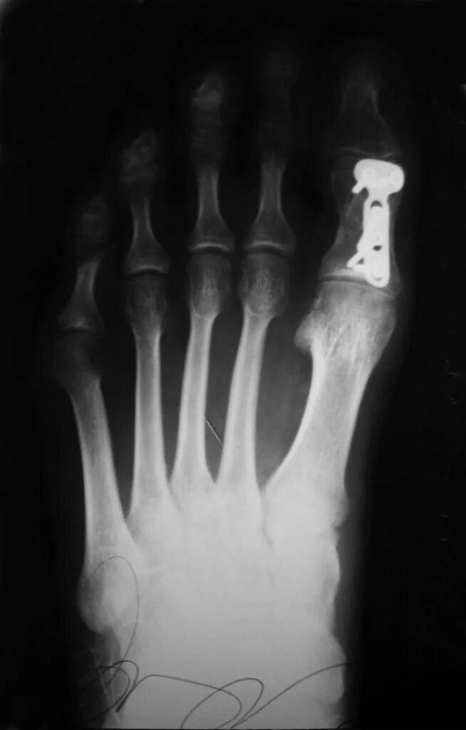 Перелом фаланги мизинца рентгенограмма. Оскольчатый перелом дистальной фаланги 1 пальца ноги. Перелом основной фаланги 5 пальца ноги рентген. Перелом основной фаланги пальца стопы. Основание проксимальной фаланги 5 пальца стопы.