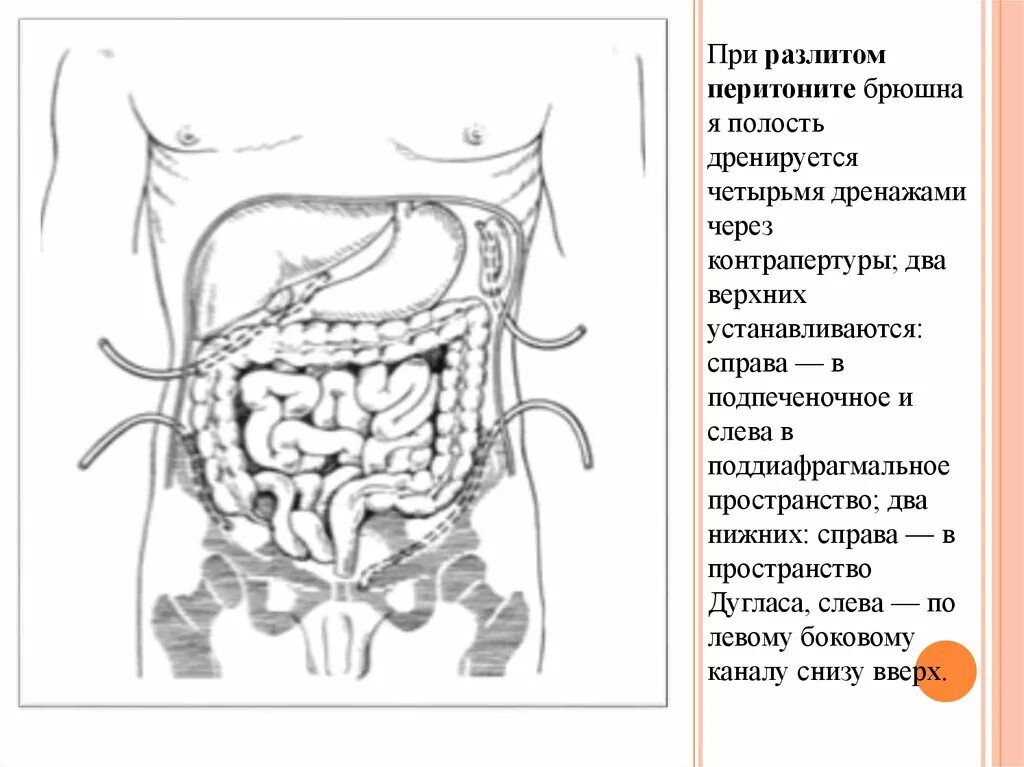 Схема дренирования брюшной полости. Схема дренирования брюшной полости при перитоните. Дренирование брюшной полости при перитоните. Методы дренирования брюшной полости при перитоните. Операция по поводу перитонита