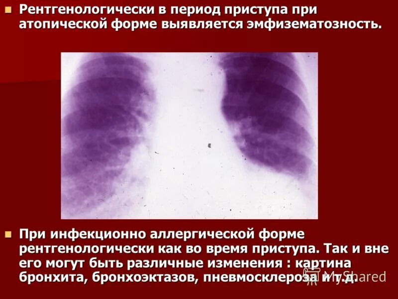 Пневмосклероз легких прогноз. Пневмосклероз рентген признаки. бронхоэктазы и пневмосклероз. болезни при которых развивается пневмосклероз.