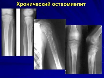 Остеомиелит кости признаки