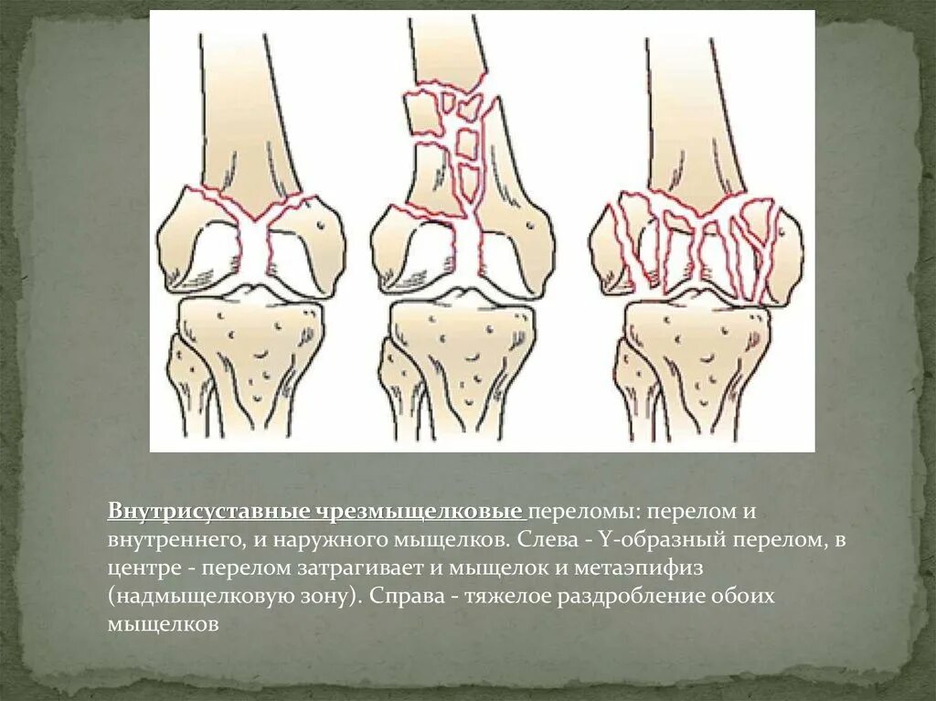 Эпифизарные переломы кости. Краевой внутрисуставной перелом. Рентген внутрисуставной перелом коленного. 1. Эпифизарный внутрисуставной перелом..