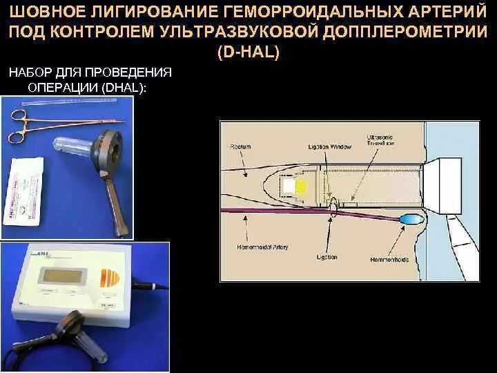 Шовное лигирование геморроидальных артерий. Аппарат для лигирования геморроидальных узлов. Лигирования геморроидальных узлов.