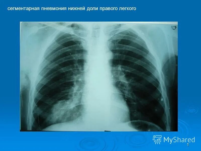 Пневмония в правой нижней доле. Сегментарная пневмоничрентген. Сегментарная пневмония у детей рентген. Левосторонняя нижнедолевая пневмония.