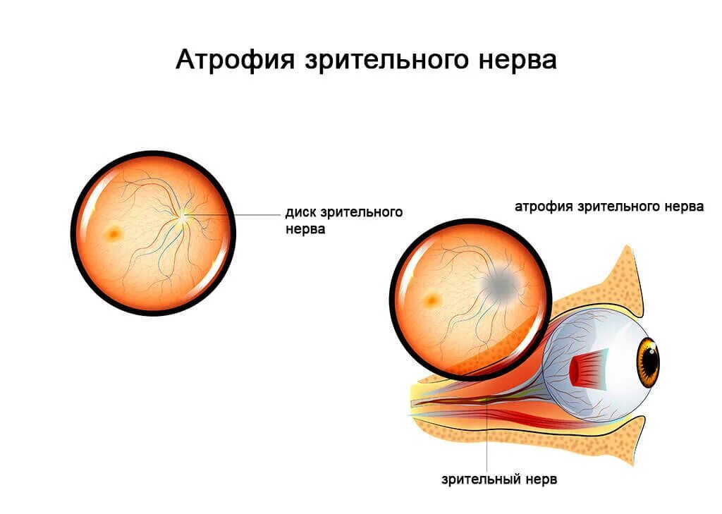 Нисходящая атрофия. Атрофия зрительного нерва Лебера. Атрофия зрителньог онерва. Дистрофия глазного нерва. Атрофия зрительного нерва этиология.