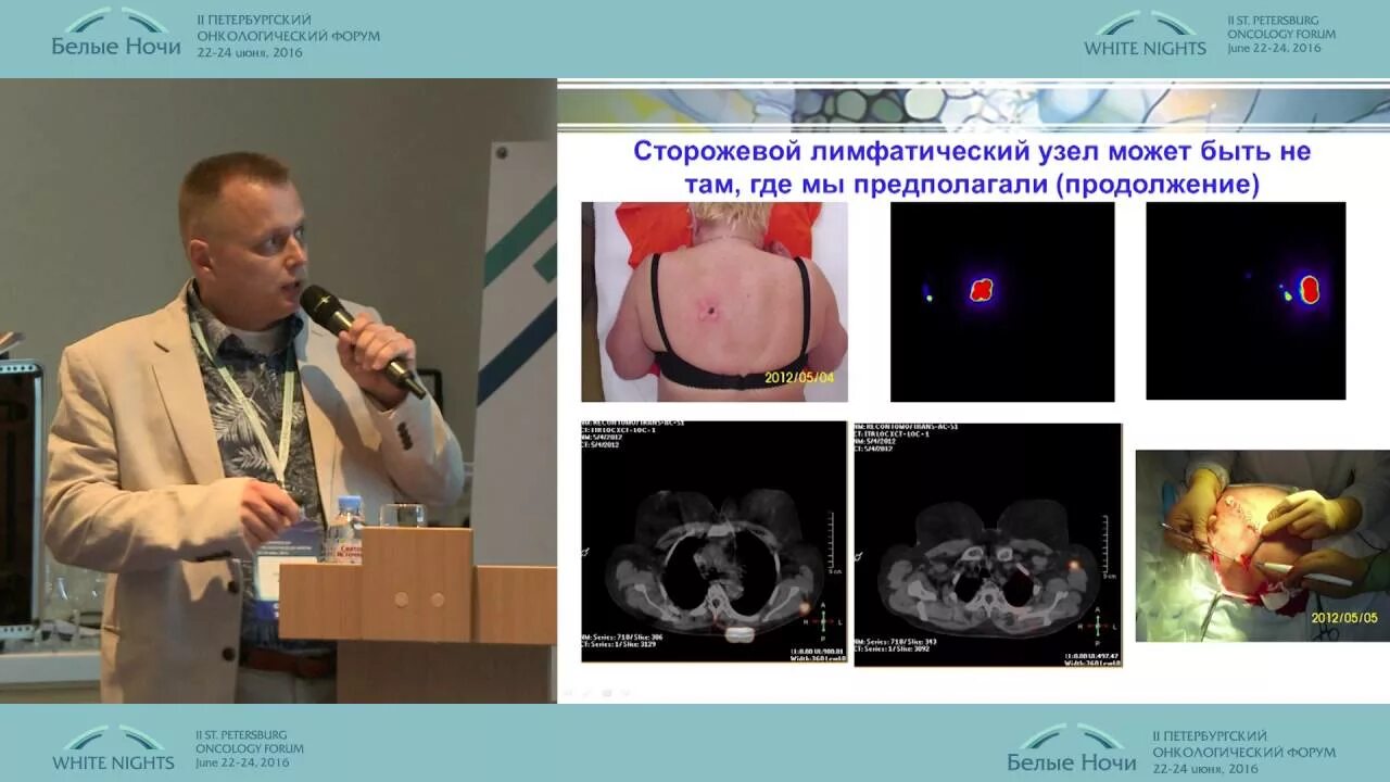 Лучевая терапия метастазов в лимфоузлах