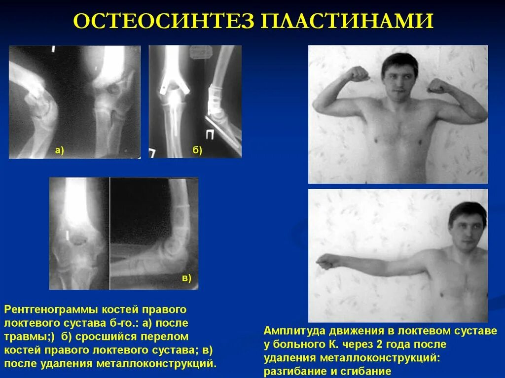 Не срастается сустав. Контрактура локтевого сустава кт. остеосинтез локтевого сустава реабилитация. сгибательная контрактура локтевого сустава степени. посттравматическая контрактура локтевого сустава.