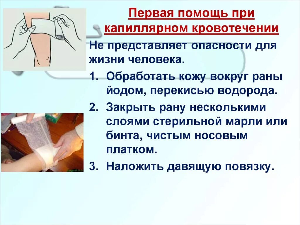 Действия при сильном кровотечении. ПП при капиллярном кровотечении. Капиллярное кровотечение первая помощь. Алгоритм оказания ПП при капелярном кроаотеч. Капиллярное кровотечение первая помощь алгоритм действий.