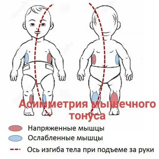 Гипертонус языка это