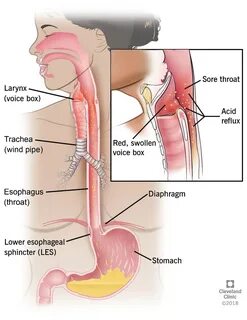 Lpr Reflux, Reflux Diet, Post Nasal Drip Remedy, Silent Reflux, Swallowing ...