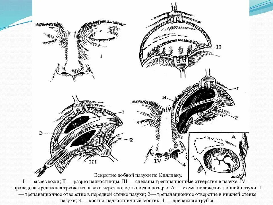 Фронтотомия. Эндоназальное вскрытие решетчатого лабиринта. Операция киллиана на лобной пазухе. Гайморовы пазухи анатомия гайморит. Операция на лобной пазухе по киллиану.