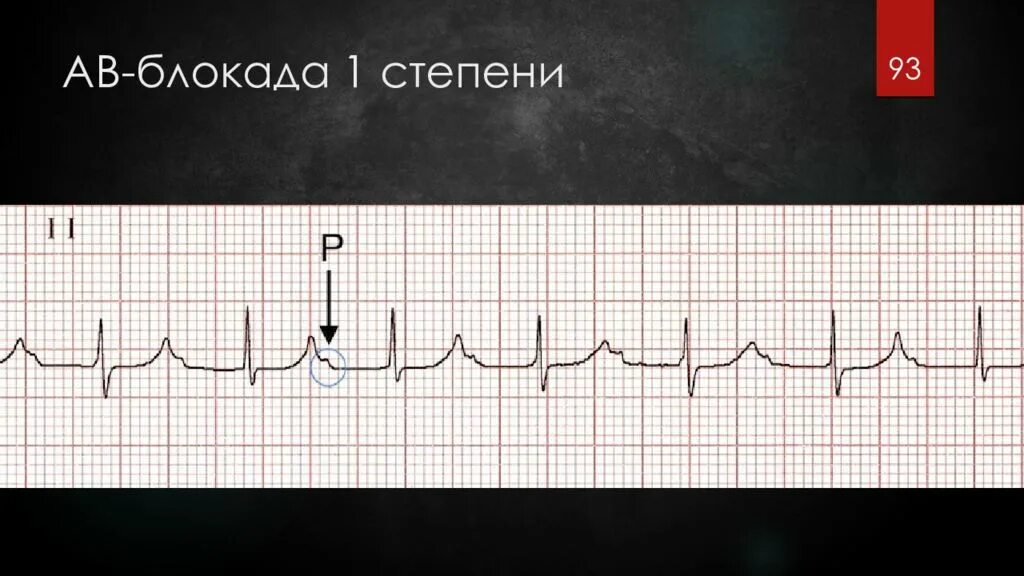 Блокада на первом. ЭКГ при АВ блокаде 1 степени. Неполная АВ блокада 1 степени на ЭКГ. Атриовентрикулярная блокада 1 степени на ЭКГ. АВ блокада 1 степени на ЭКГ.