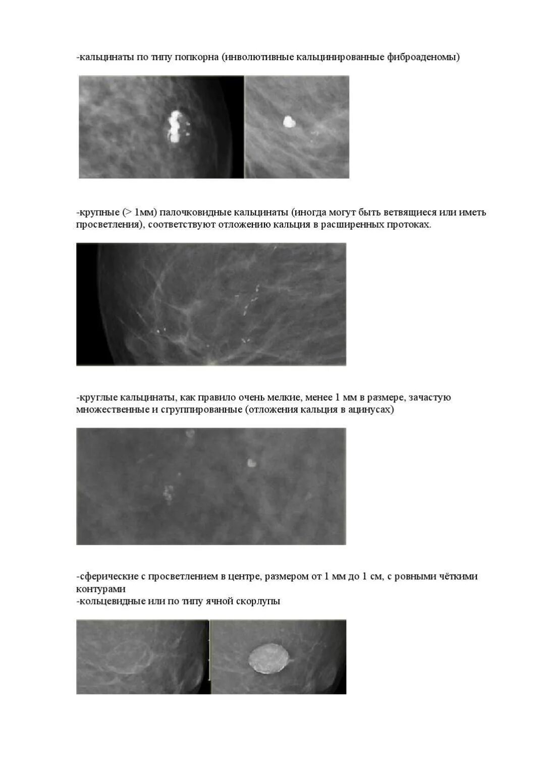 Округлые кальцинаты. Микрокальцинаты в молочной железе на маммографии. Маммография раковые микрокальцинаты. Палочковидные кальцинаты. Сосудистые кальцинаты маммография.