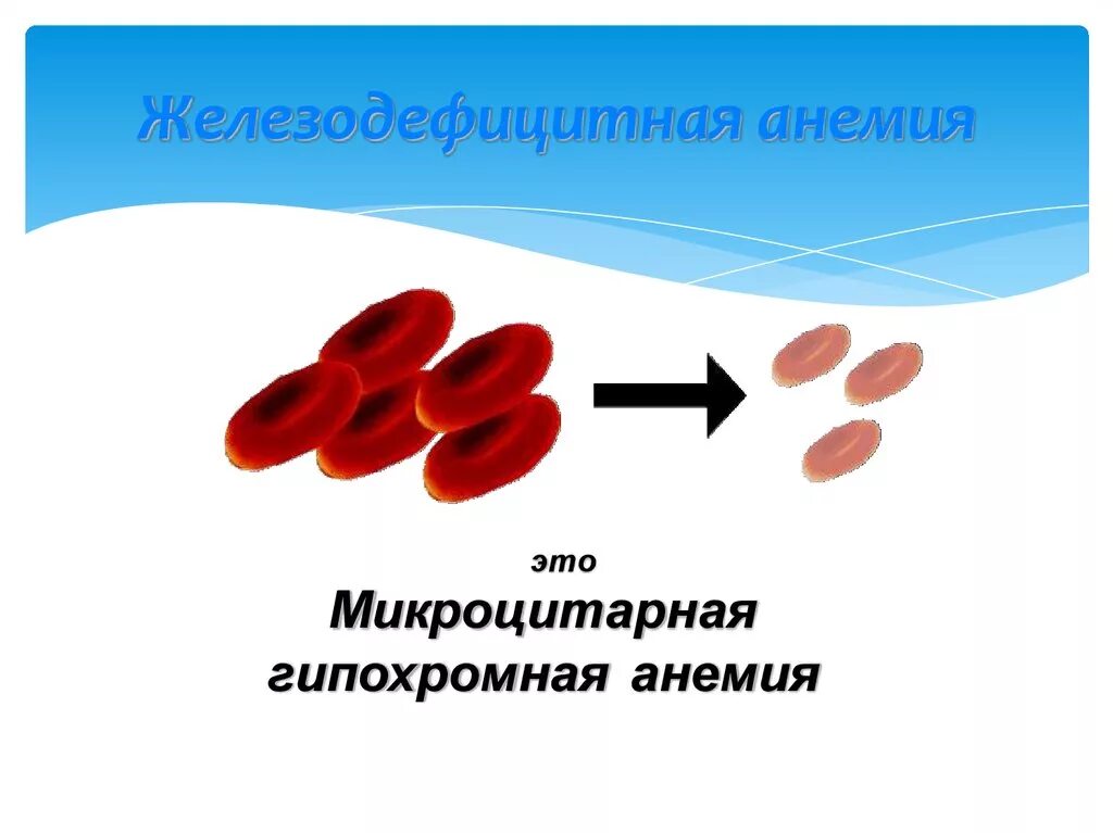 Железодефицитная анемия микроцитарная. Железодефицитная анемия гипохромная. Железодефицитная анемия у детей.