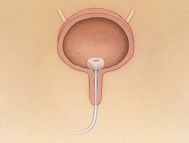 Трубочку в мочевой пузырь
