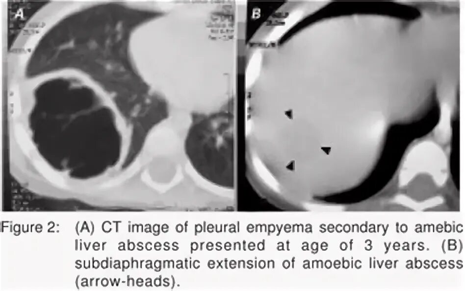 Эмпиема латынь. Treatment of Pleural Effusion.