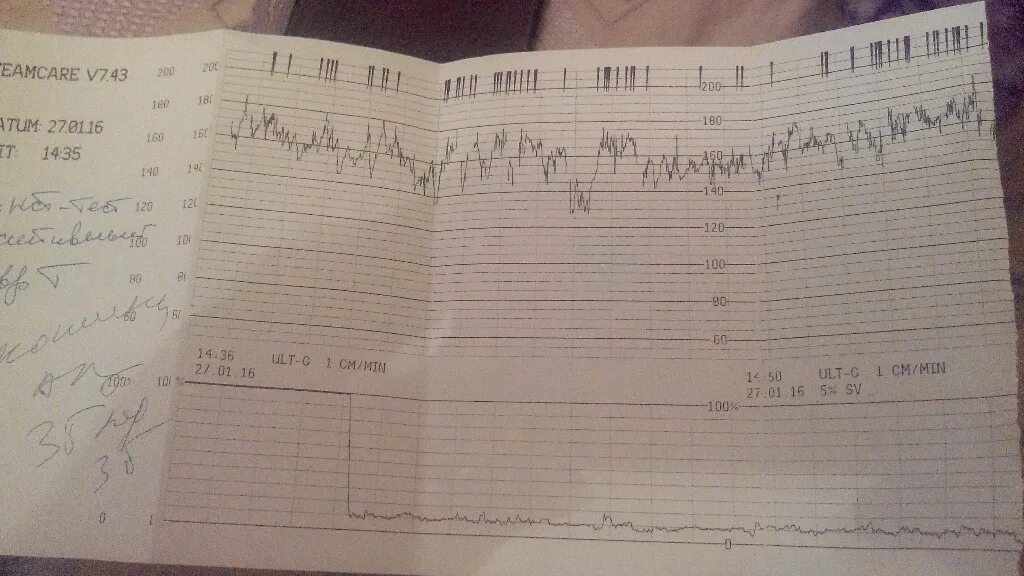 35 недель плохо. КТГ норма. КТГ плода норма. КТГ при беременности. Плохое КТГ.