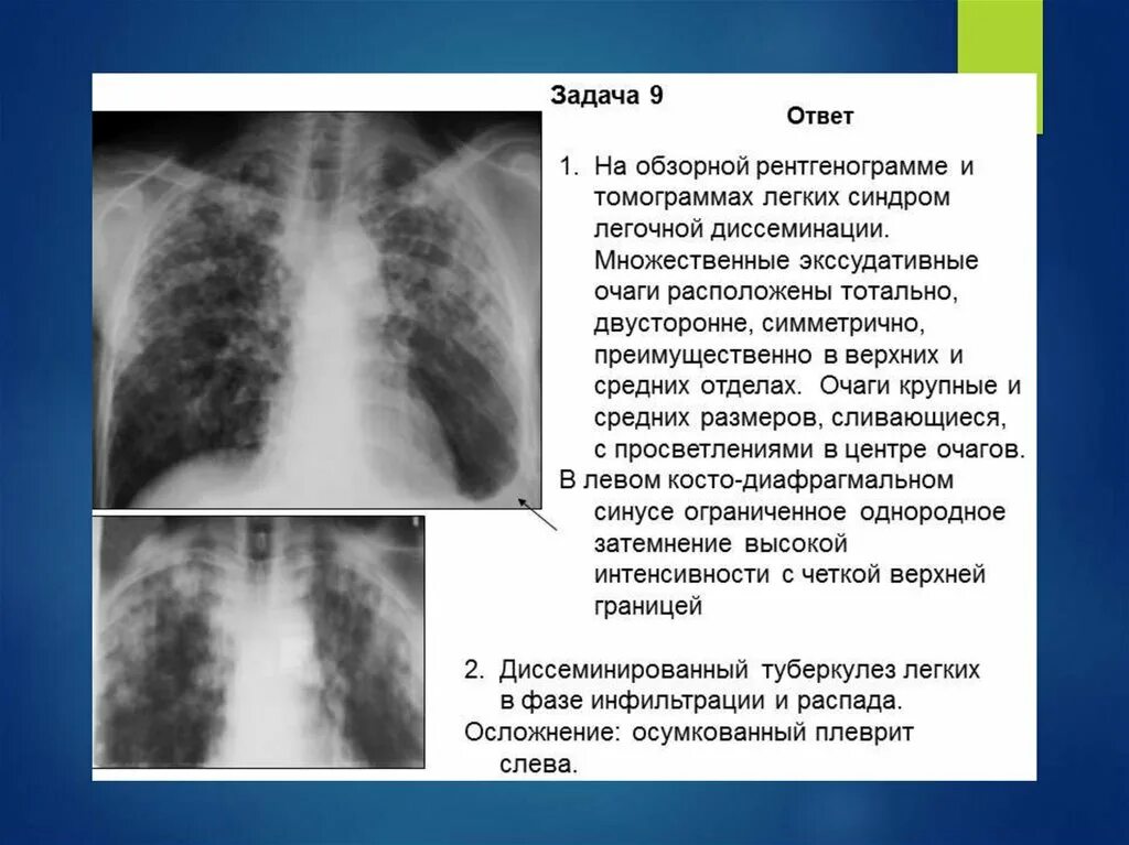 Диссеминированный туберкулез фаза инфильтрации