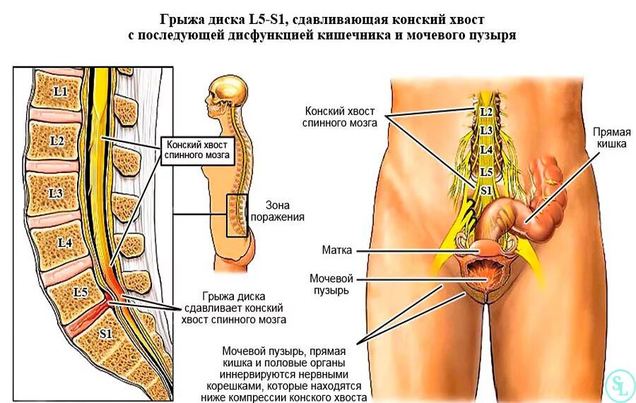 Очень болит грыжа. Диски l5-s1 в позвоночнике. грыжа l5-s1. межпозвонковый диск l5-s1. позвоночный диск l5-s1 расположение.