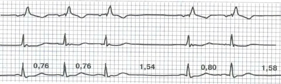 Са блокада 2 тип. Блокада синоатриального узла на ЭКГ. Блокада са узла ЭКГ. Синоатриальная блокада 2 степени на ЭКГ. Синоаурикулярная блокада 2 степени на ЭКГ.