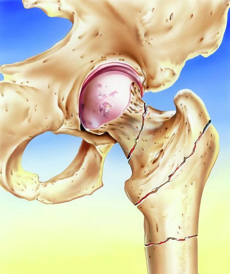 Компрессионный перелом шейки бедра. Тазобедренный сустав шейка бедра. Хирургическая шейка бедра. Шейка бедра заживает