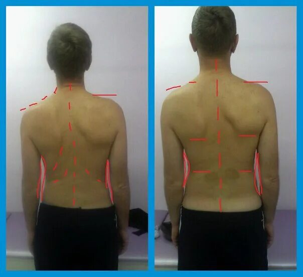 Талия со сколиозом 2 степени. Правосторонний сколиоз th7 l1. Анталгический сколиоз поясничного отдела. С-образный сколиоз поясничного отдела. Массаж после операции на позвоночнике