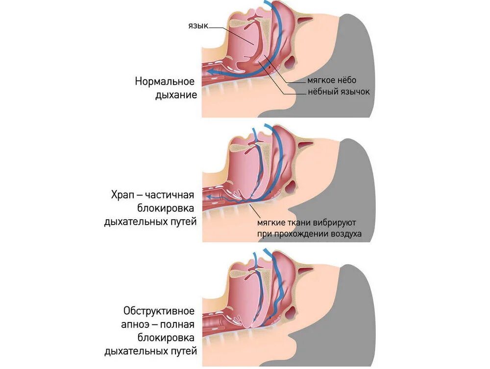 Храпит мужчина причины. Храп механизм возникновения.