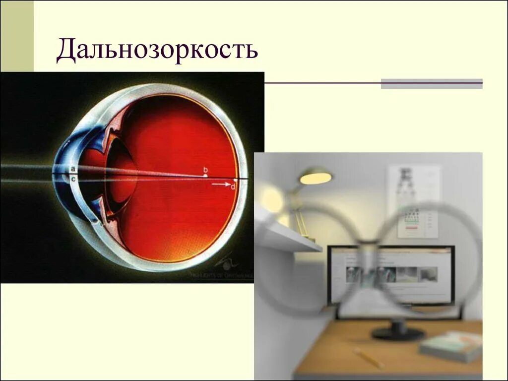 Дальнозоркость. Близорукость и дальнозоркость. Дальнозоркость картинки. Болезнь дальнозоркость