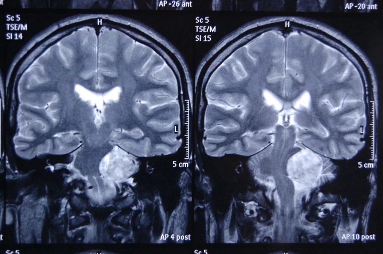 Мрт головного мозга санкт петербург. Менингиома мозжечка мрт. Мрт головного мозга (с прицелом на мостомозжечковые углы). Опухоли мостомозжечкового угла мрт.
