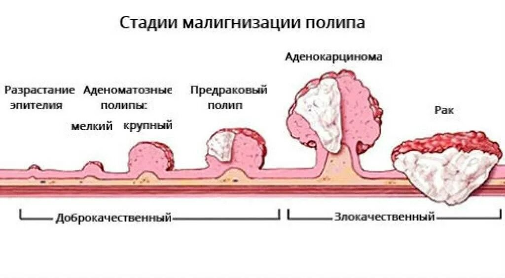 Аденоматозные полипы эндометрия. Ворсинчатый аденоматозный полип. Классификация полипов матки. Эпителиальное образование желудка что это