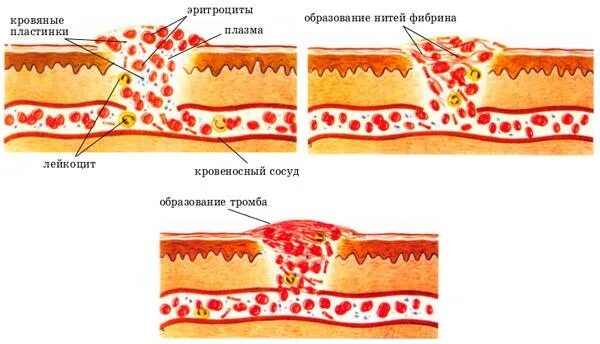 Количество фибрина после пореза. Фибрин (это желтая плотная ткань на ране),. Фибриновые нити в ране.
