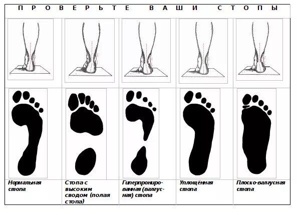 Подъем стопы. Высокий свод стопы у ребенка. Высокий свод стопы высота. Плоскостопие и полая стопа.