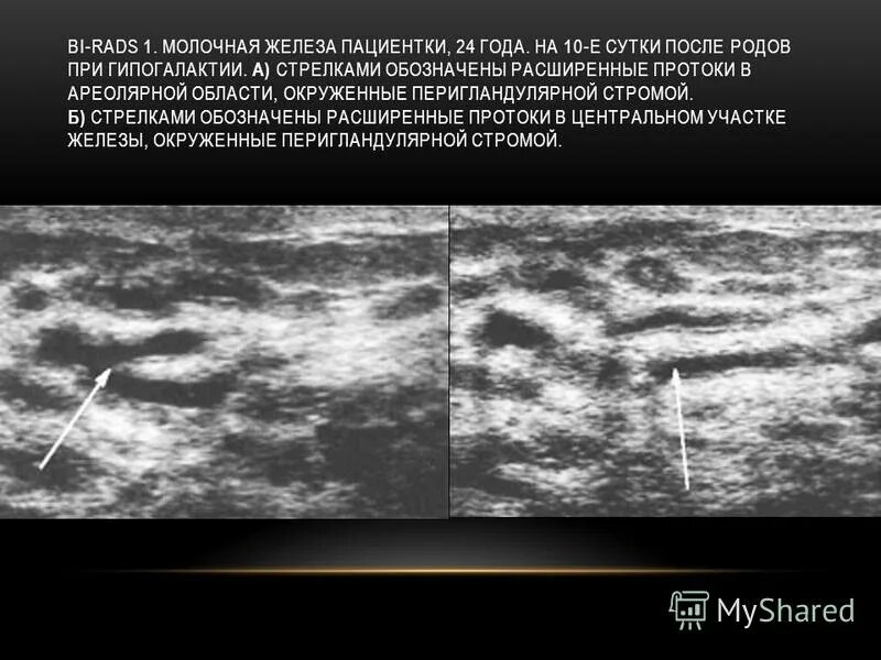 Справа bi rads 2. Бирадс 4. Маммография бирадс. Классификация bi-rads молочных желез в УЗИ. Таблица бирадс УЗИ молочных желез.