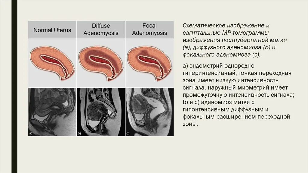 Диффузная форма матки. Толщина переходной зоны матки. Аденомиоз переходная зона. Диффузный аденомиоз матки мрт.