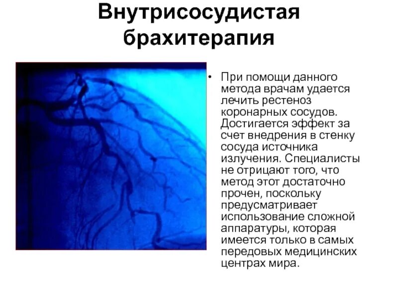 Эффект достигается за счет. Внутрисосудистая брахитерапия. Внутритканевая брахитерапия. Контактная лучевая терапия брахитерапия это. Внутритканевая лучевая терапия.