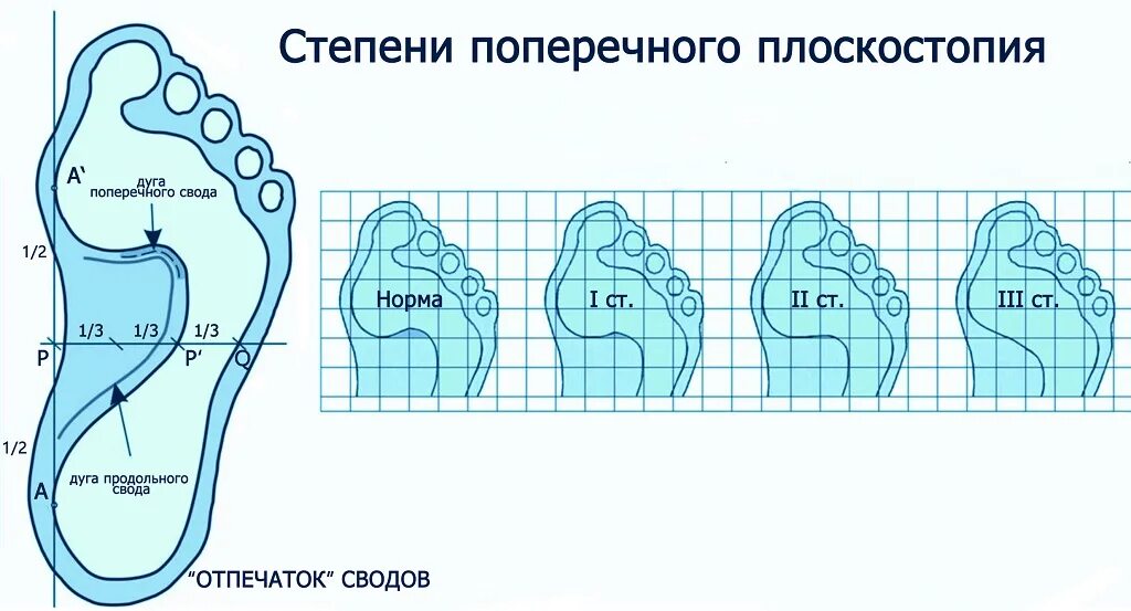 Поперечное 1 степени. Двустороннее поперечное плоскостопие 1 степени. Степени продольного и поперечного плоскостопия. Продольно-поперечное плоскостопие 2 степени. Продольно-поперечное плоскостопие градусы.