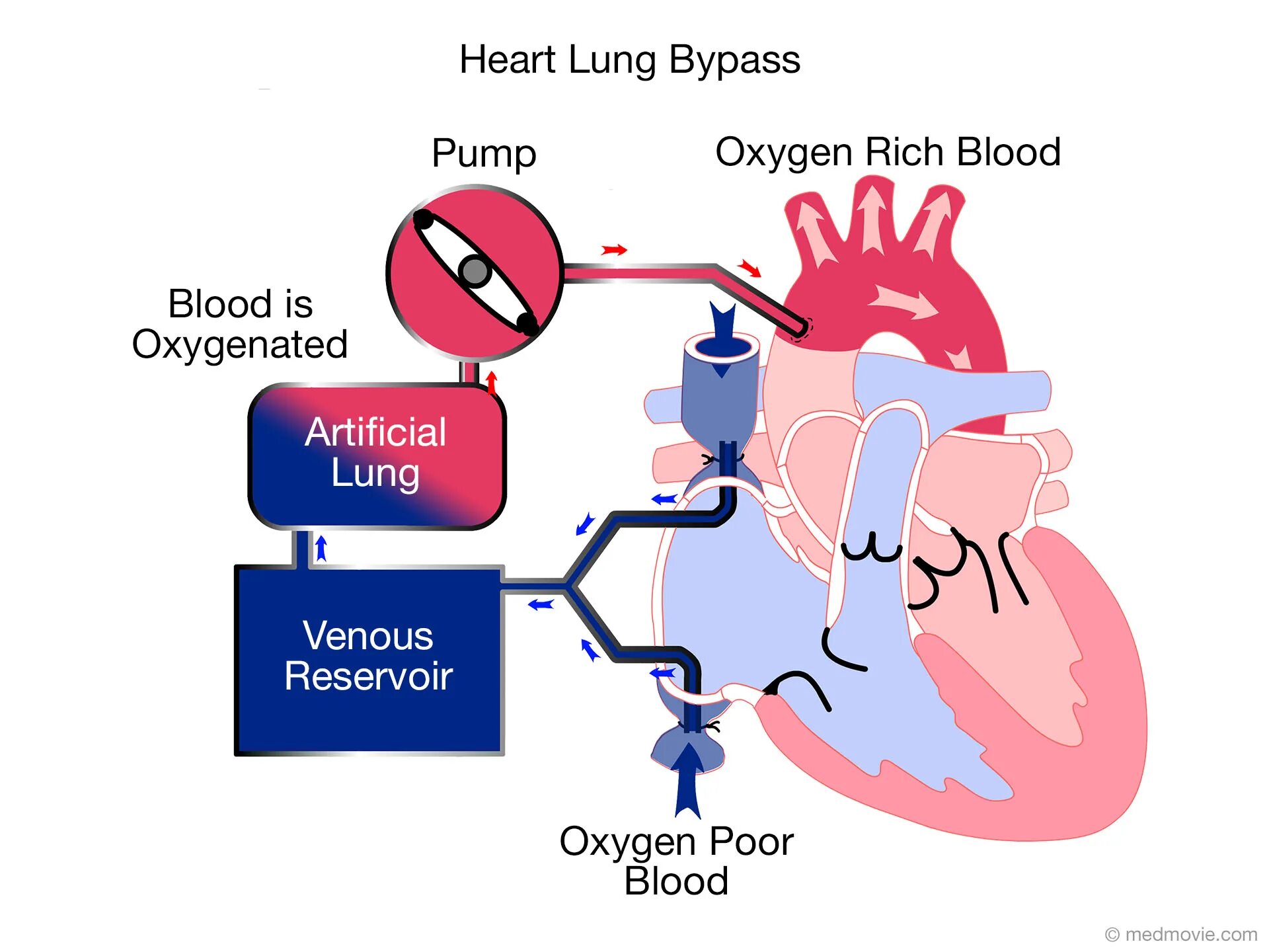 Bypass mode. Cardiopulmonary bypass machine.