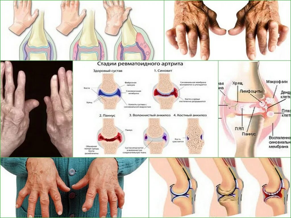 Скованность при ревматоидном артрите. Схема поражения суставов при ревматоидном артрите. Ревматоидный артрит диагностика стадии. Стадия 2 ревматоидного артрита кистей. Клинические формы ревматоидного артрита.