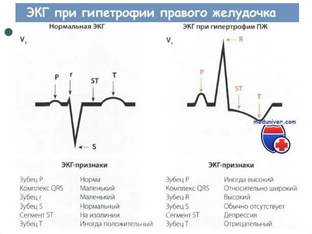 ЭКГ при гипертрофии левого правого желудочка. Гипертрофия левого желудочка и правого желудочка на ЭКГ. ЭКГ признаки гипертрофии правого желудочка на ЭКГ. Критерии гипертрофии правого и левого желудочка на ЭКГ. Экг преобладание левого желудочка